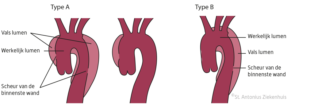 Dissectie Aortadissectie (splijting van de grote lichaamsslagader) | St. Antonius ...