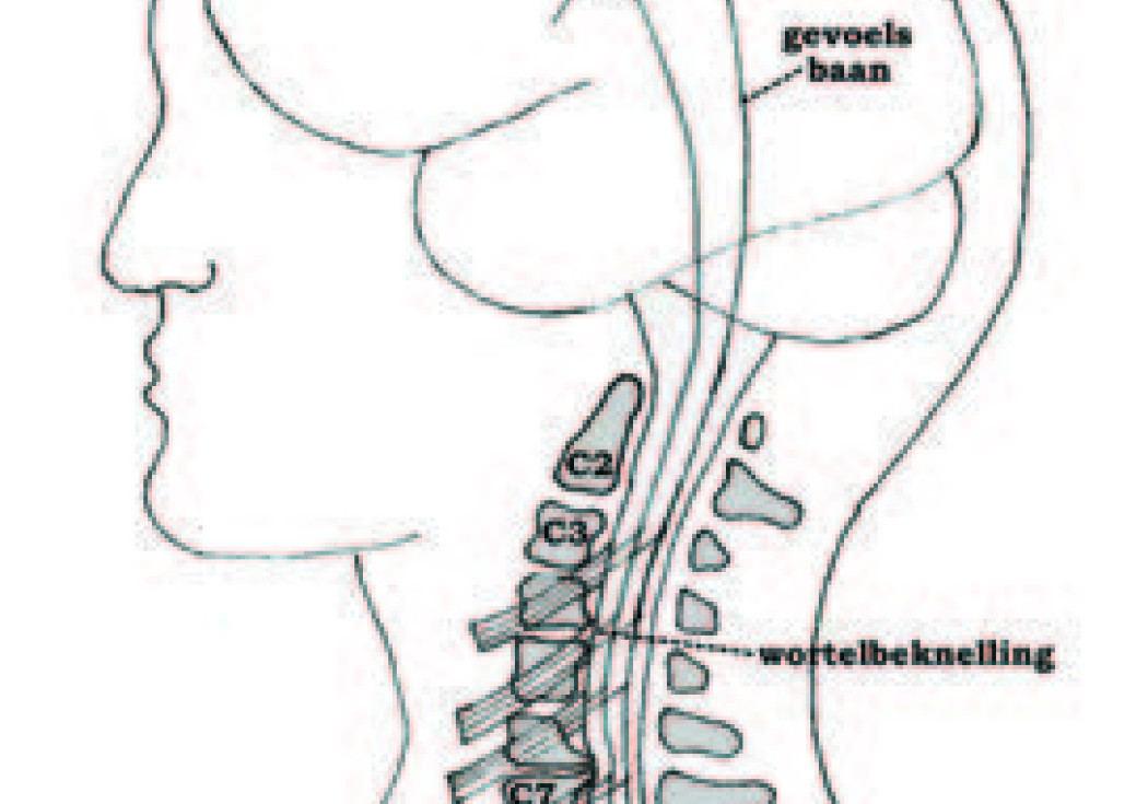 Wervel-, wortelkanaalvernauwing en nekhernia (operatie) | St. Antonius