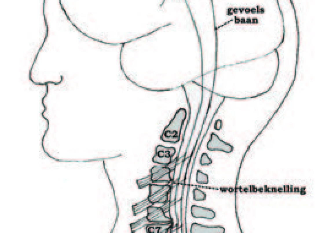Wervel-, wortelkanaalvernauwing en nekhernia (operatie) | St. Antonius