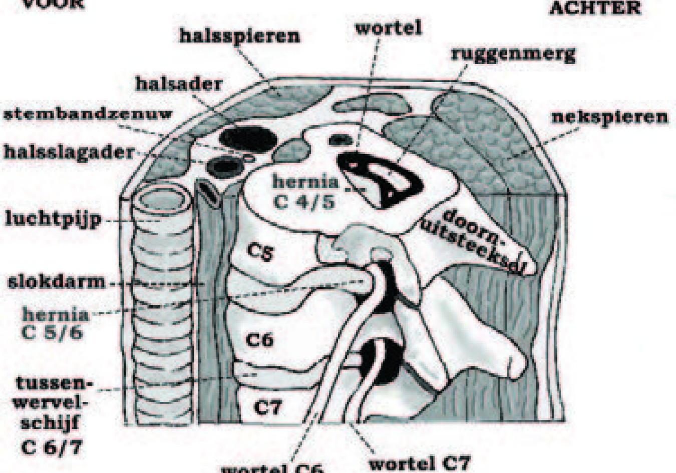 Wervel-, wortelkanaalvernauwing en nekhernia (operatie) | St. Antonius