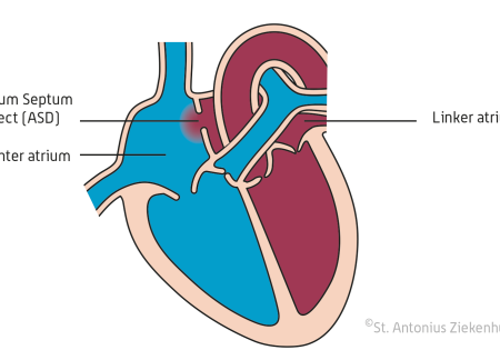 Omgekeerde Ontslag nemen Afvoer Het sluiten van Atrium Septum Defect (ASD) | St. Antonius Ziekenhuis