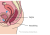 Diagram van verzakking van de voorwand van de vagina