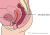 Diagram van verzakking van de achterwand van de vagina