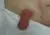 Stomaprolaps