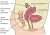 Tekening van buik met locaties van endometriose