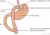 Een schematische weergave van en gastric bypass