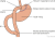 Een schematische weergave van en gastric bypass