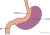 Een schematische weergave van en gastric sleeve