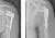 Röntgenfoto's van een schoudergewricht waarbij de kop van het gewricht operatief is vastgezet aan de schacht