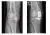Röntgenfoto's van een eenzijdig versleten kniegewricht en het gewricht met een halve knieprothese