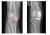 Röntgenfoto's van een eenzijdig versleten kniegewricht en het gewricht met een halve knieprothese