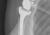 Röntgenfoto van een reversed schouderprothese waarbij de kom aan de arm zit en de kop aan de schouder.