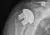 Röntgenfoto van een stemless schouderprothese waarbij de kop in het bovenste gedeelte van de bovenarm vastgezet wordt.