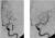 Herseninfarct opgeheven na dotterbehandeling (rechts)