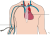 ingebrachte centrale catheter