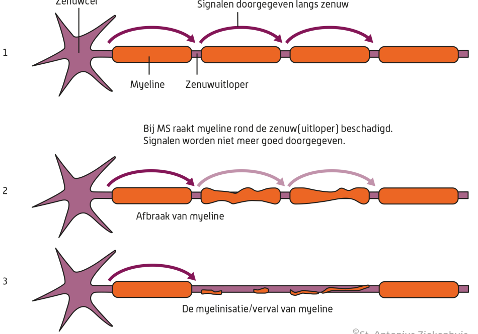 MS (Multiple Sclerose) | St. Antonius Ziekenhuis