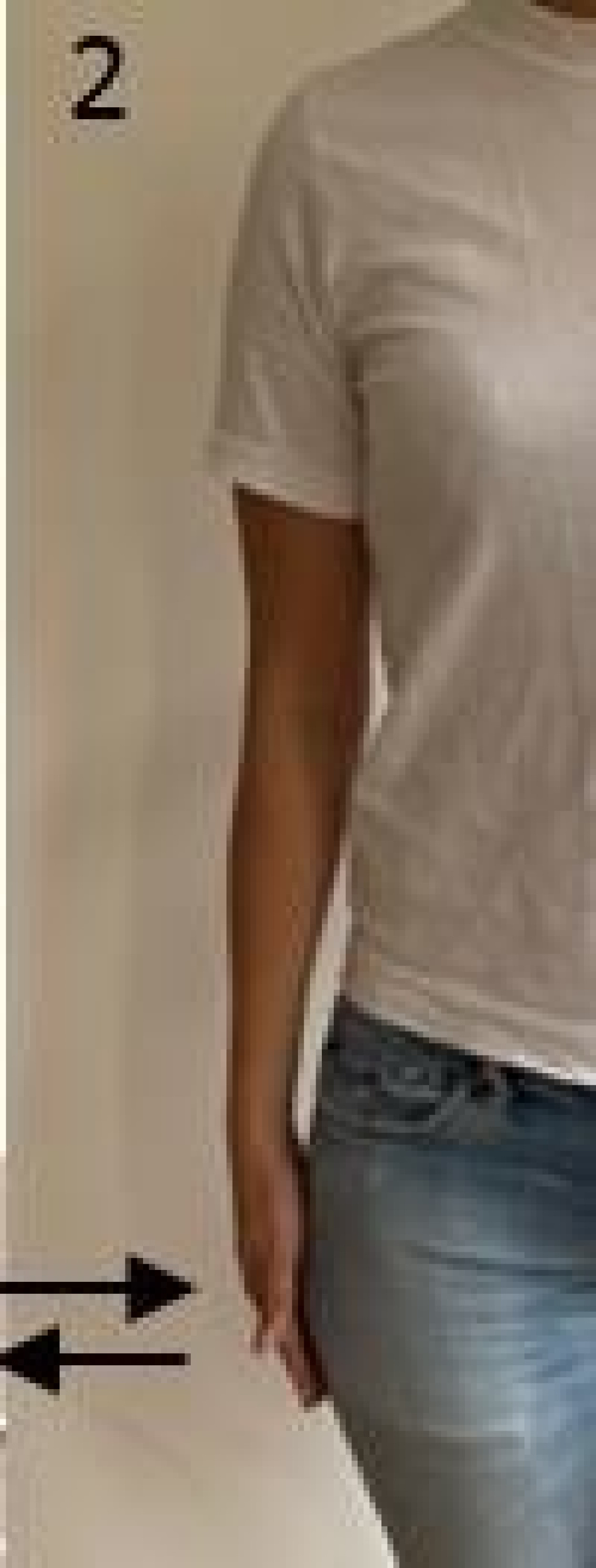 Dislocated collarbone St. Antonius Ziekenhuis