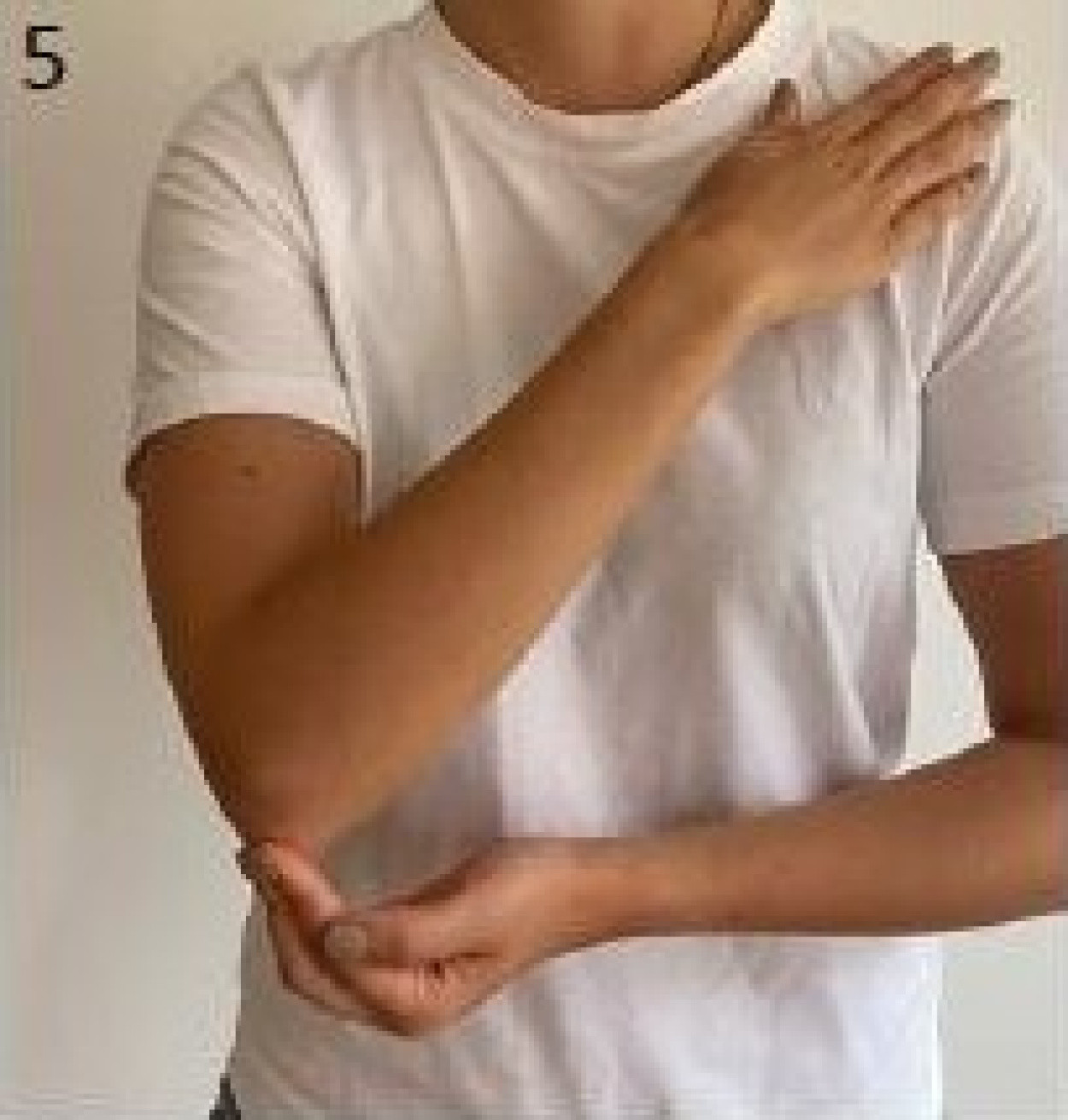 Dislocated collarbone St. Antonius Ziekenhuis