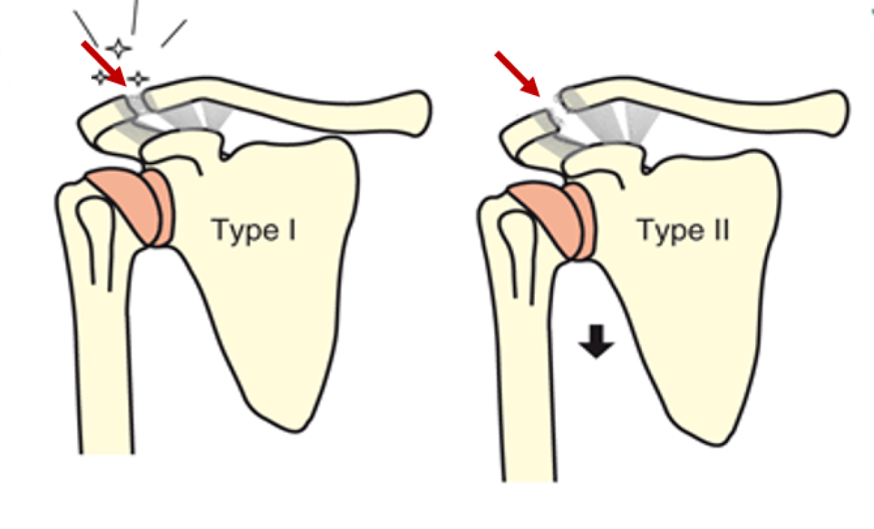 Dislocated collarbone St. Antonius Ziekenhuis
