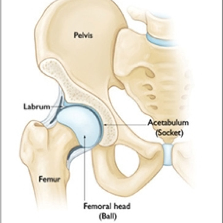 Impingement en/of labrumscheur van de heup St. Antonius Ziekenhuis