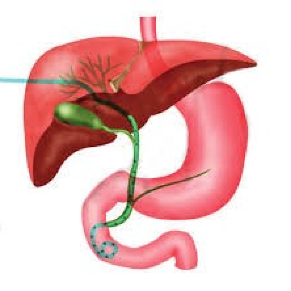 Naar huis met een percutane galwegdrain (PTC) St. Antonius Ziekenhuis