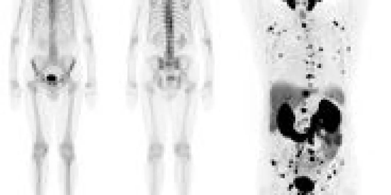 psma_pet_scan