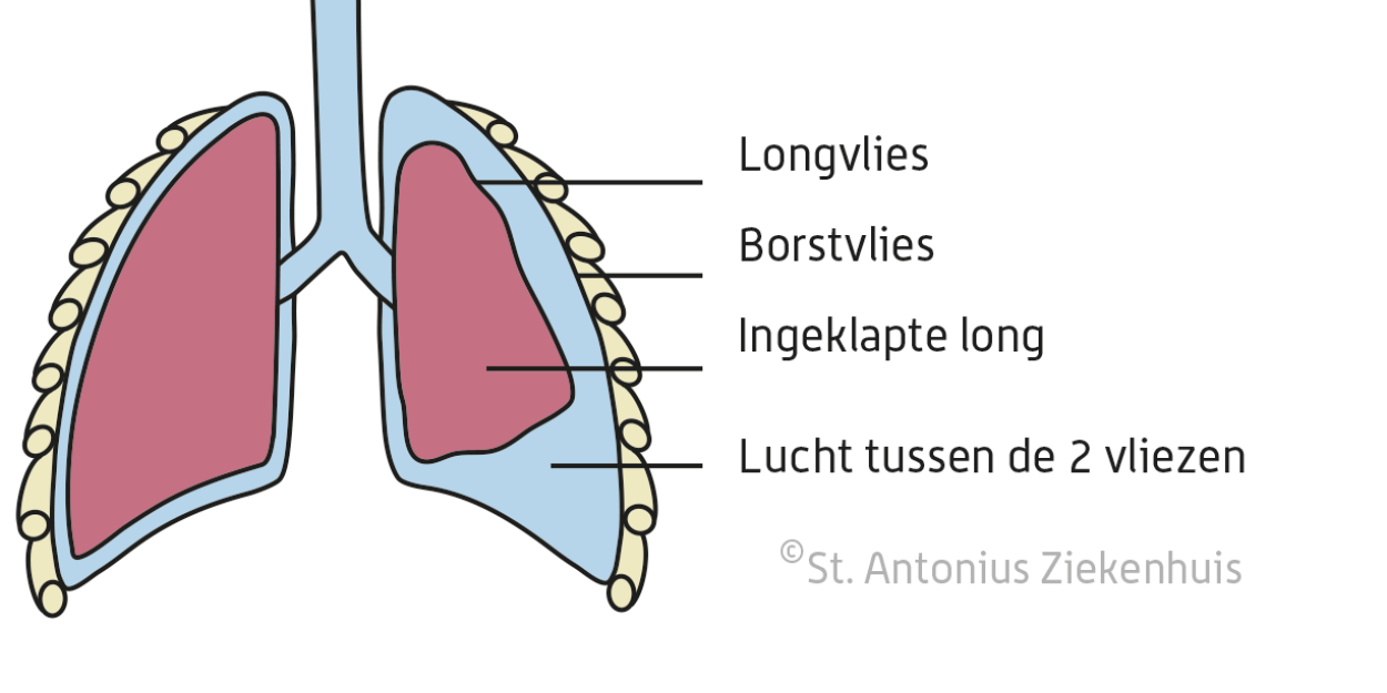 Klaplong | St. Antonius Ziekenhuis
