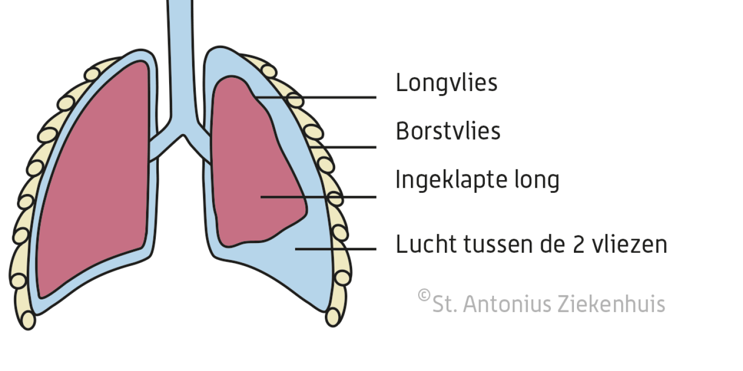 klaplong-st-antonius-ziekenhuis