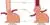 Normale slokdarm (links) versus een Barret slokdarm (rechts)