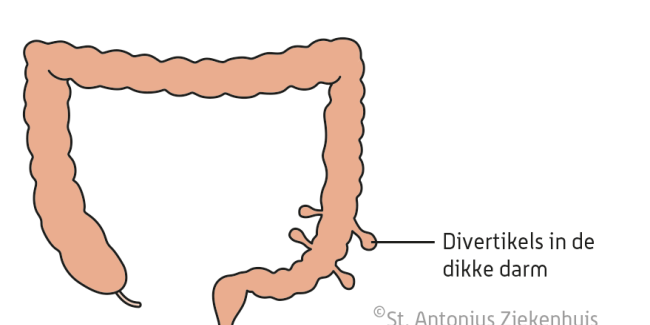 Diverticulitis | St. Antonius Ziekenhuis