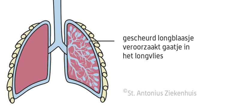 Klaplong | St. Antonius Ziekenhuis