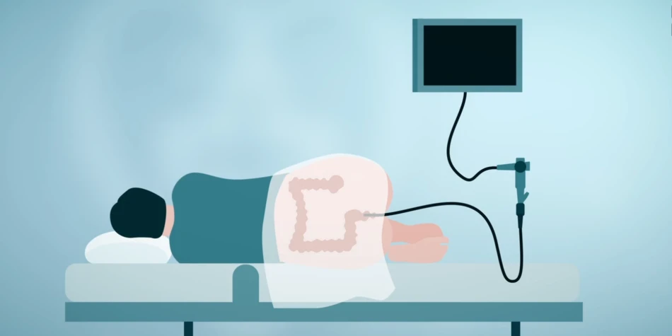 videovoorlichting over endeldarmkanker