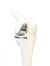 Modelfoto van een halve knieprothese in een kniegewricht