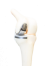 Modelfoto van een halve knieprothese in een kniegewricht