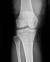 Röntgenfoto van een kniegewricht