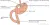 Een schematische weergave van en gastric bypass