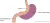 Een schematische weergave van en gastric sleeve