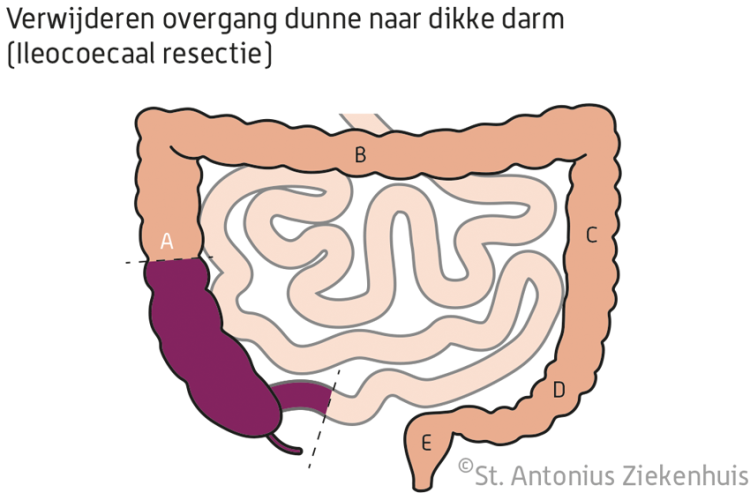 Darmoperatie St. Antonius Ziekenhuis