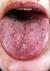 Telangiectases on the tongue of an HHT patient