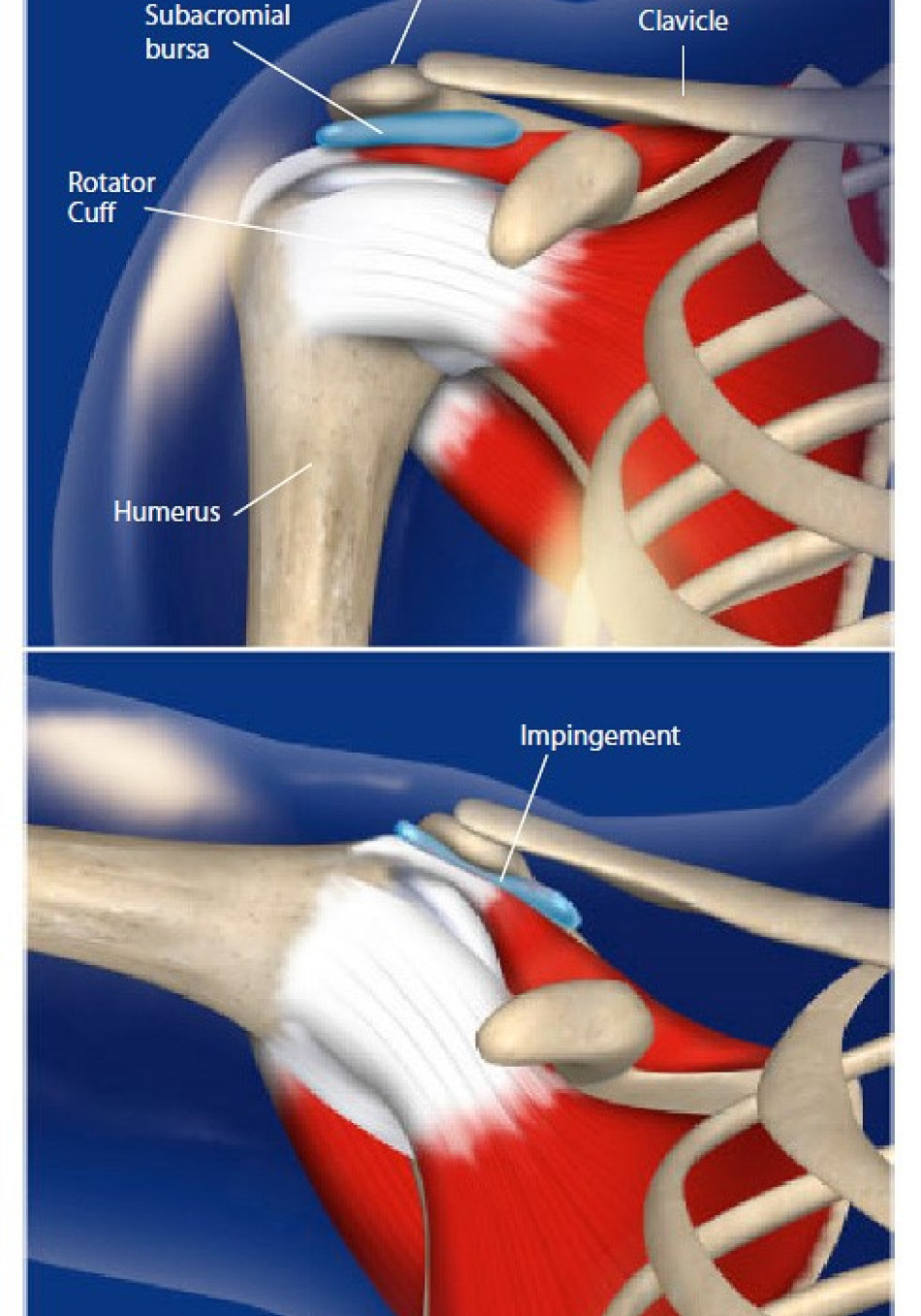 Inpingiment Impingement Symptome Nachweis : Impingementsyndrom (Engpasssyndrom) – LHIM