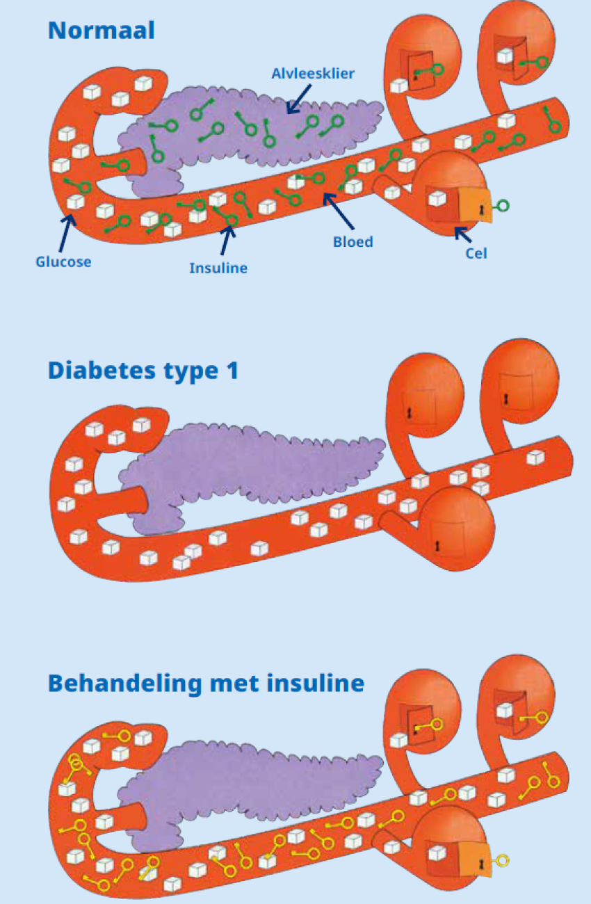 Diabetes mellitus type 1 | St. Antonius Ziekenhuis